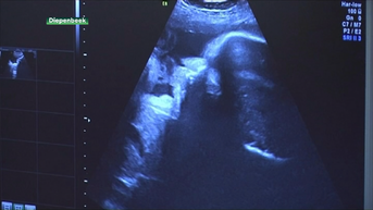 Baby’s hebben al roet in hun longen en hersenen nog voor de geboorte